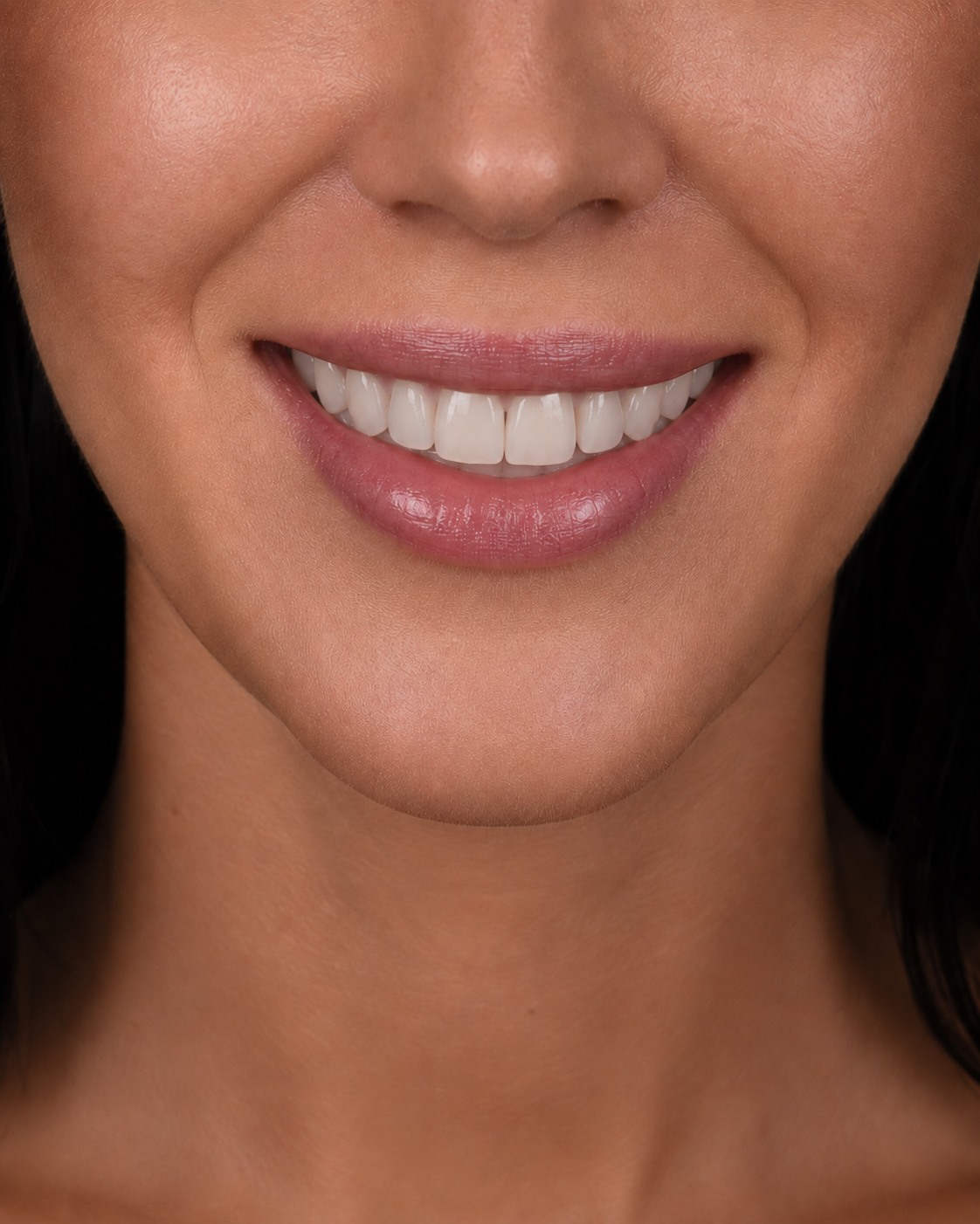 After smile transformation