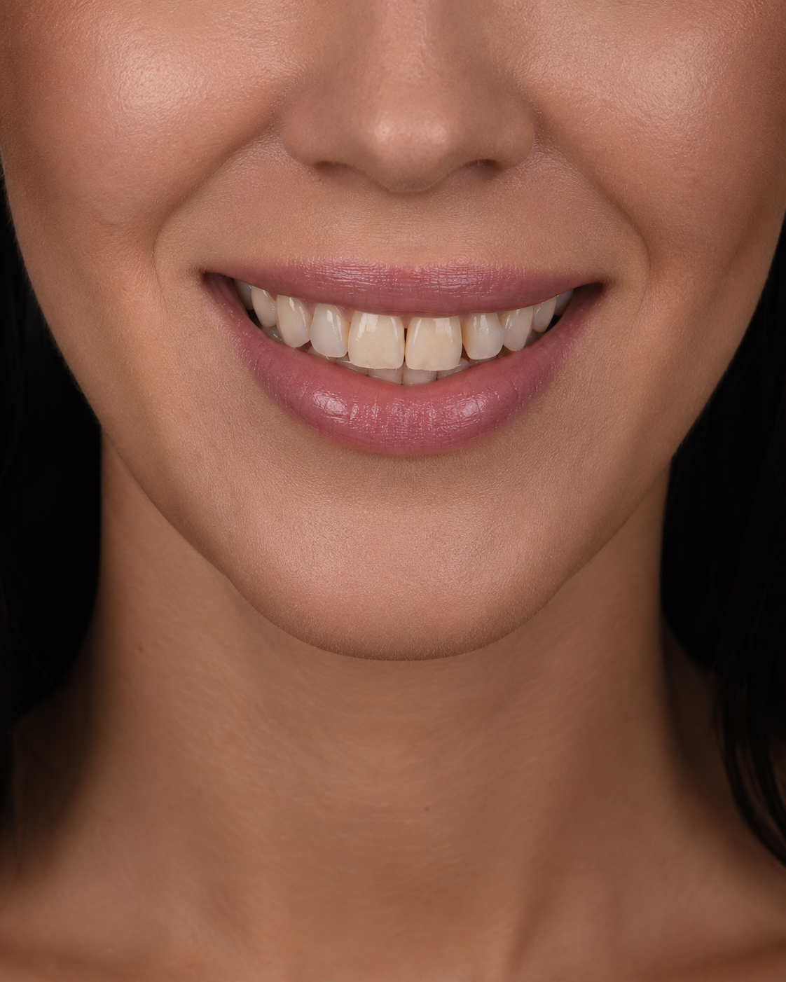 Before smile transformation